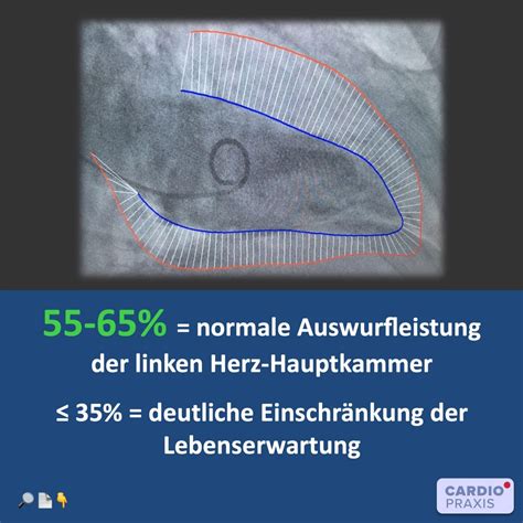 lv wert herz|Linksventrikuläre Ejektionsfraktion: Das .